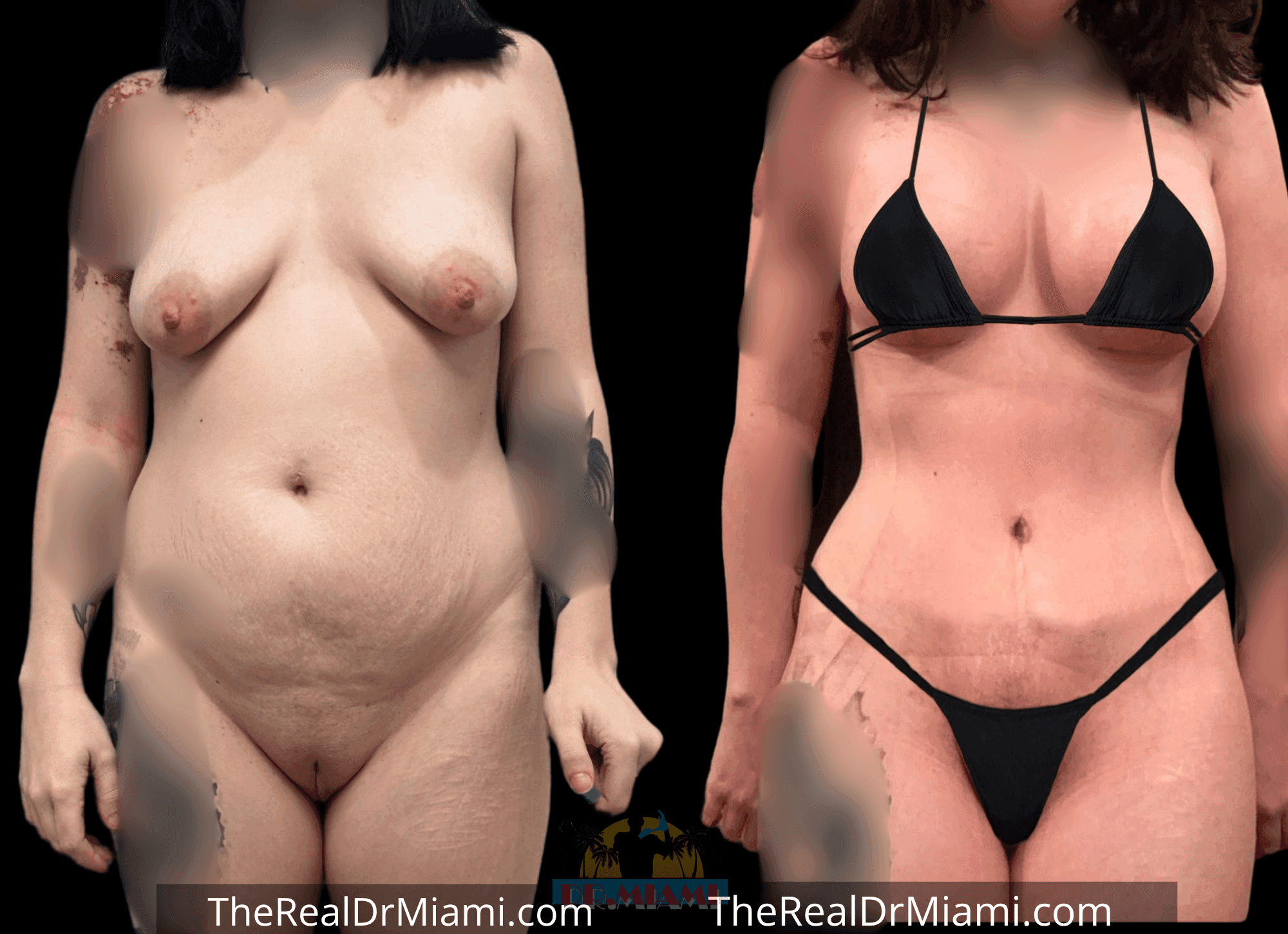 Before-and-after views for Tummy Tuck, Case 8.