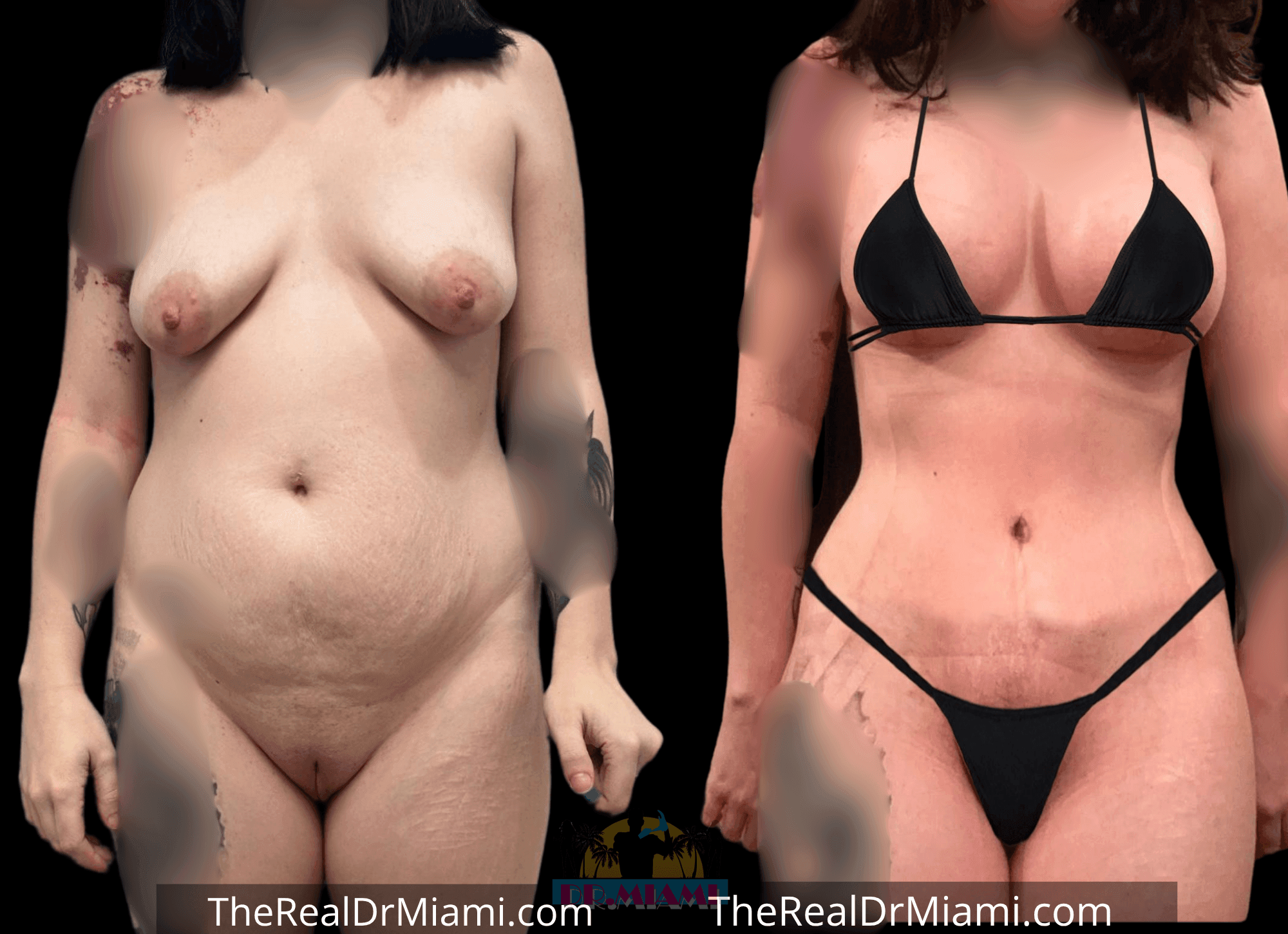 Before-and-after views for Tummy Tuck, Case 8.