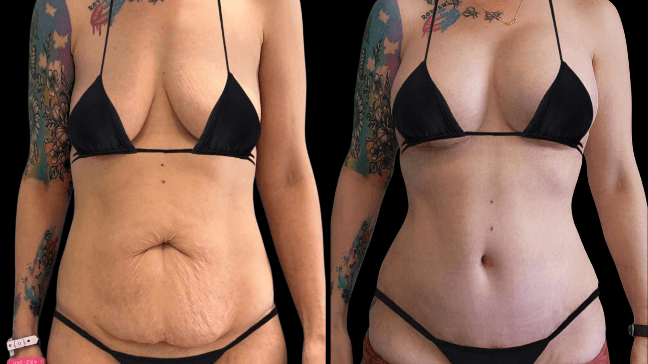Before-and-after views for Mommy Makeover, Case 4 from The Next Dr. Miami collection.