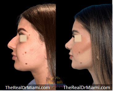 Before-and-after views for Rhinoplasty, Case 127.