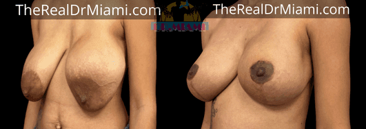 Before-and-after views for Breast Lift, Case 91.