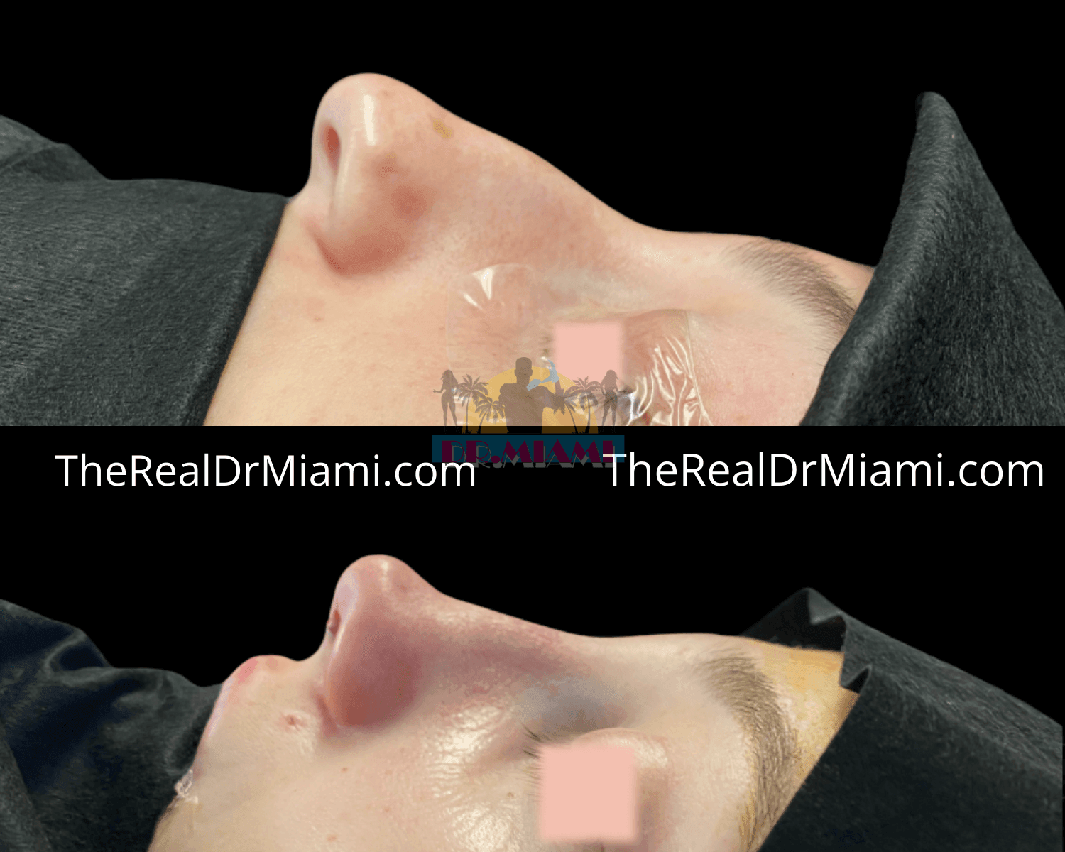 Before-and-after views for Rhinoplasty, Case 4.