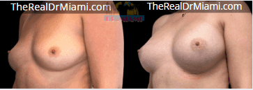 Before-and-after views for Breast Augmentation, Case 16.