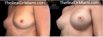 Before-and-after views for Breast Augmentation, Case 16.