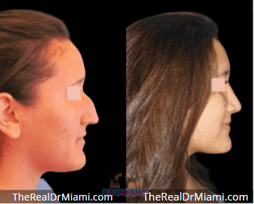 Before-and-after views for Rhinoplasty, Case 63.