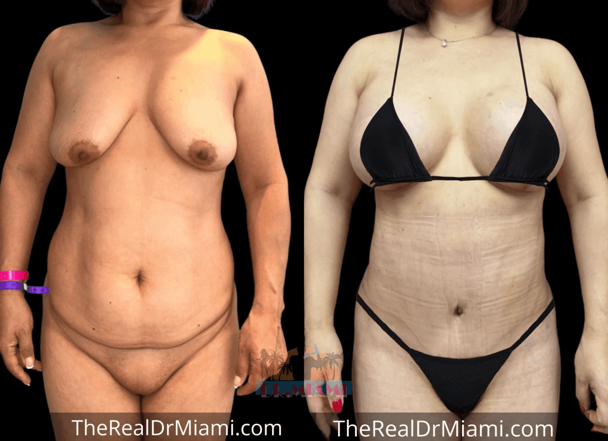 Before-and-after views for Mommy Makeover, Case 57.