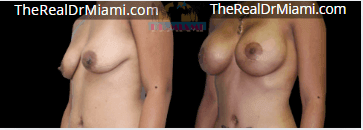 Before-and-after views for Breast Augmentation, Case 25.