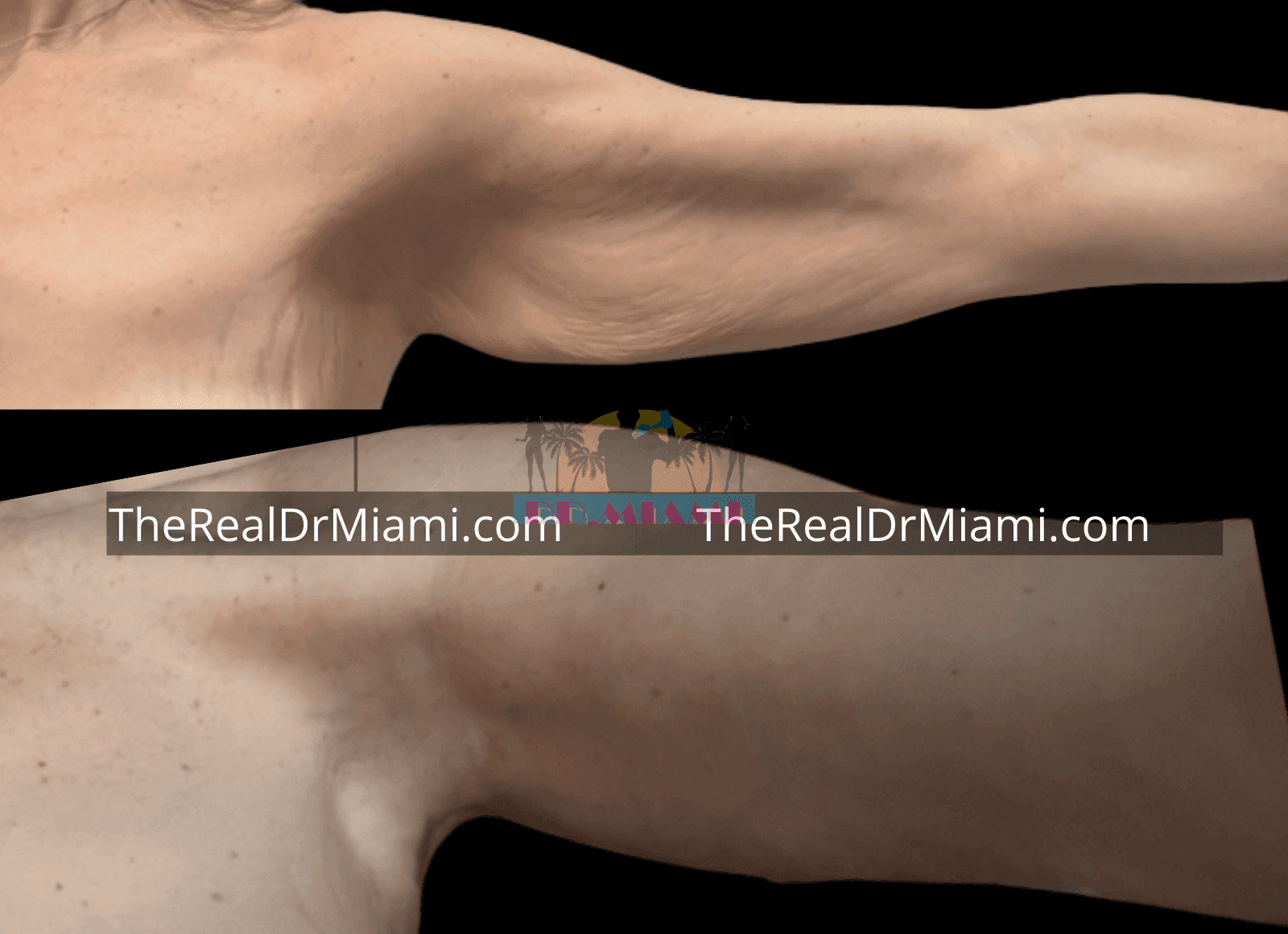 Before-and-after views for Upper Arm Lift, Case 10.