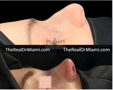 Before-and-after views for Rhinoplasty, Case 109.