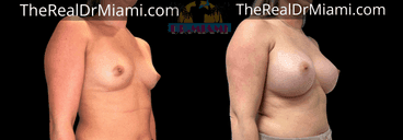 Before-and-after views for Breast Augmentation, Case 77.