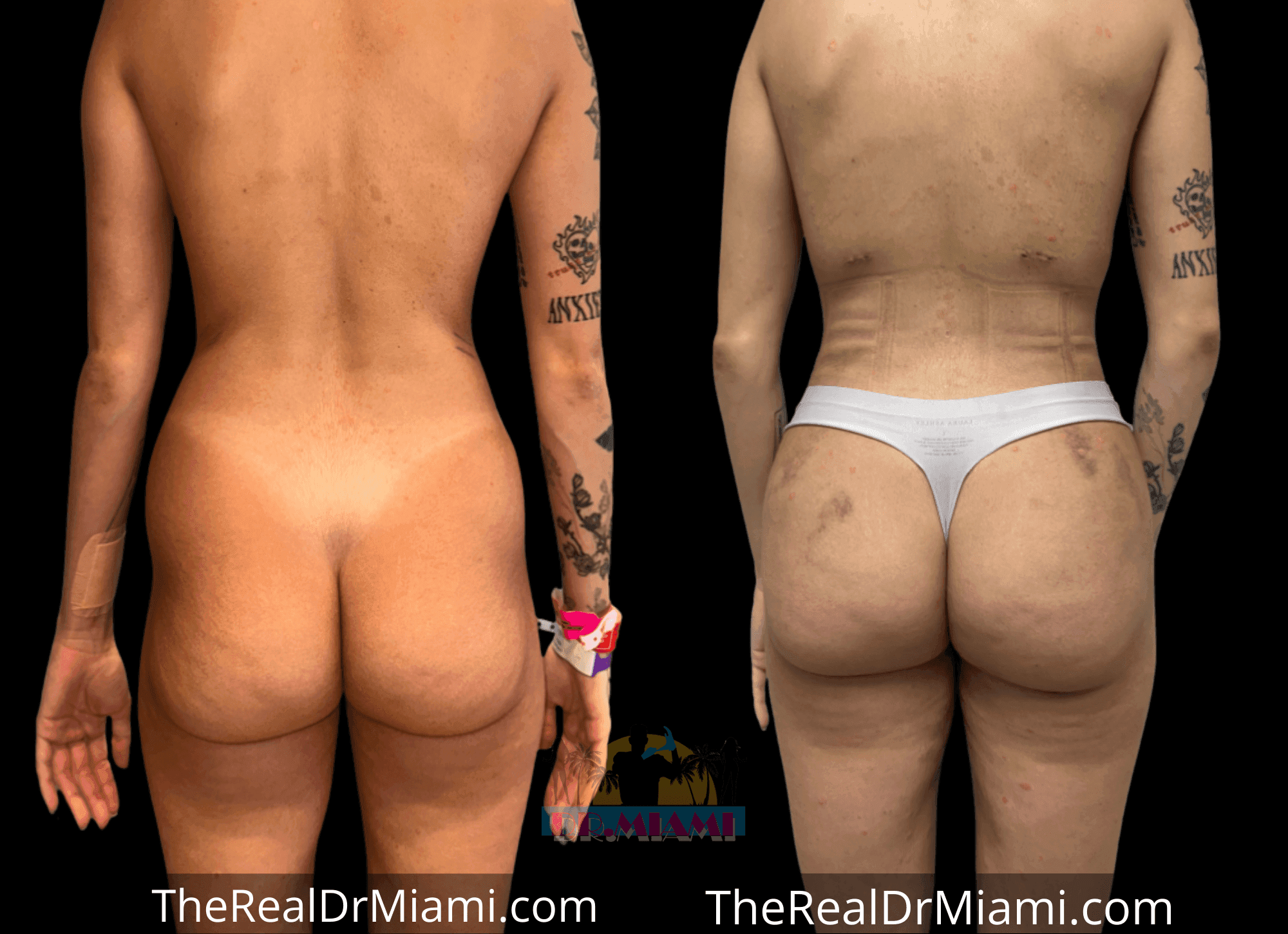 Before-and-after views for Brazilian Butt Lift, Case 90.