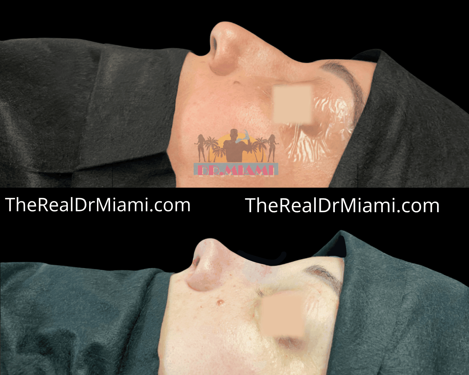Before-and-after views for Rhinoplasty, Case 28.