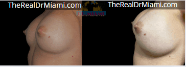 Before-and-after views for Breast Augmentation, Case 48.