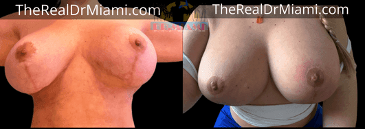 Before-and-after views for Breast Lift, Case 82.