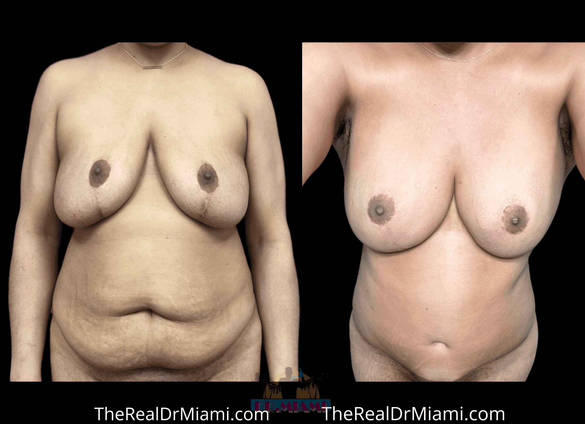 Before-and-after views for Mommy Makeover, Case 37.