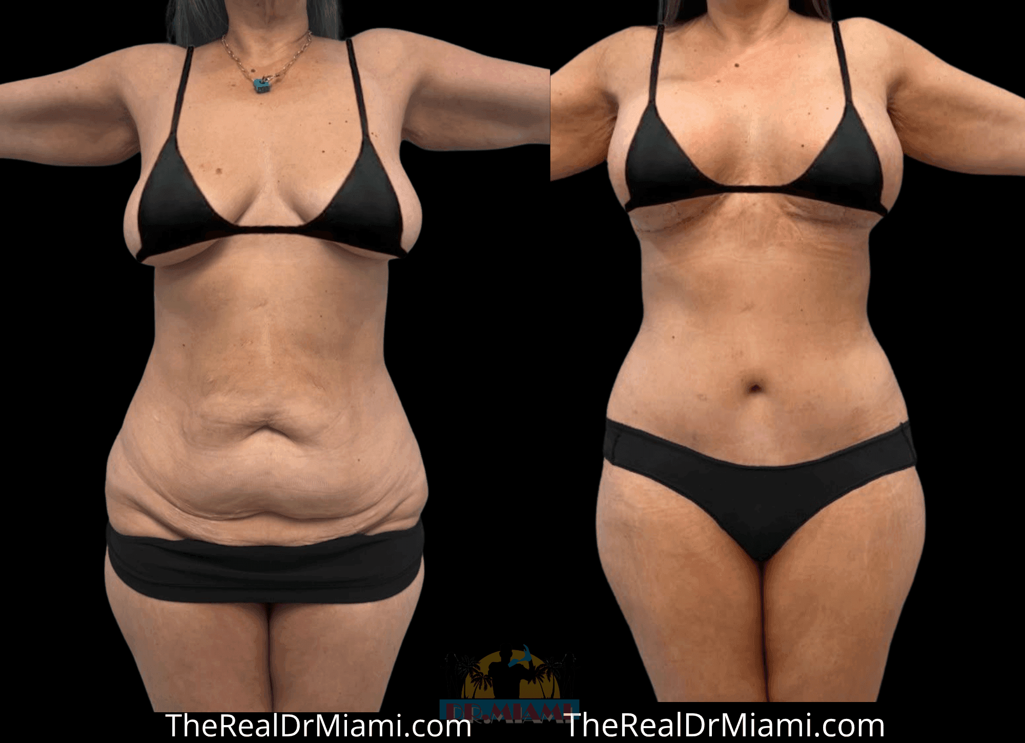 Before-and-after views for Tummy Tuck, Case 117 — Additional result.