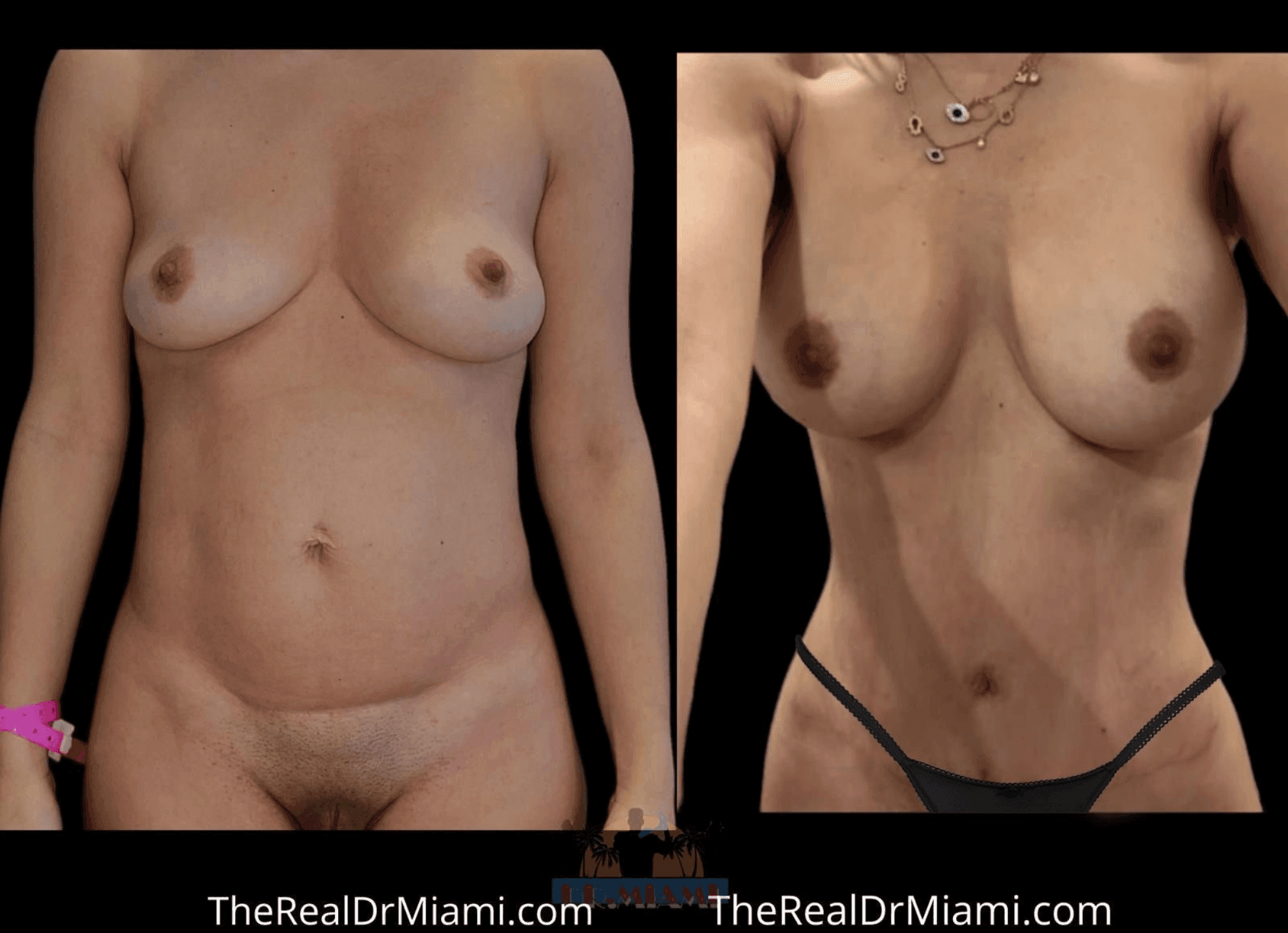 Before-and-after views for Mommy Makeover, Case 18.