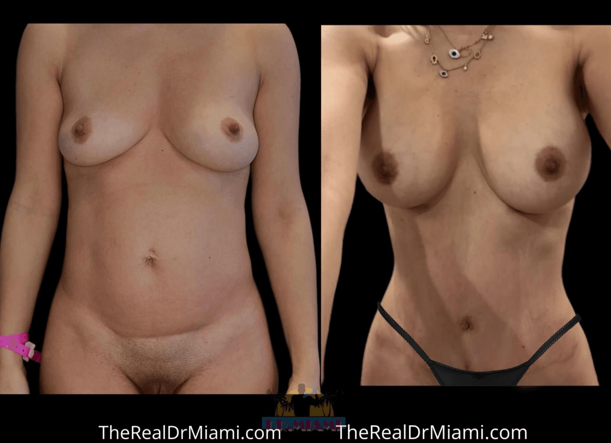 Before-and-after views for Mommy Makeover, Case 18.