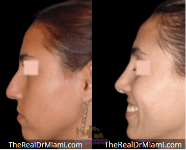 Before-and-after views for Rhinoplasty, Case 98.