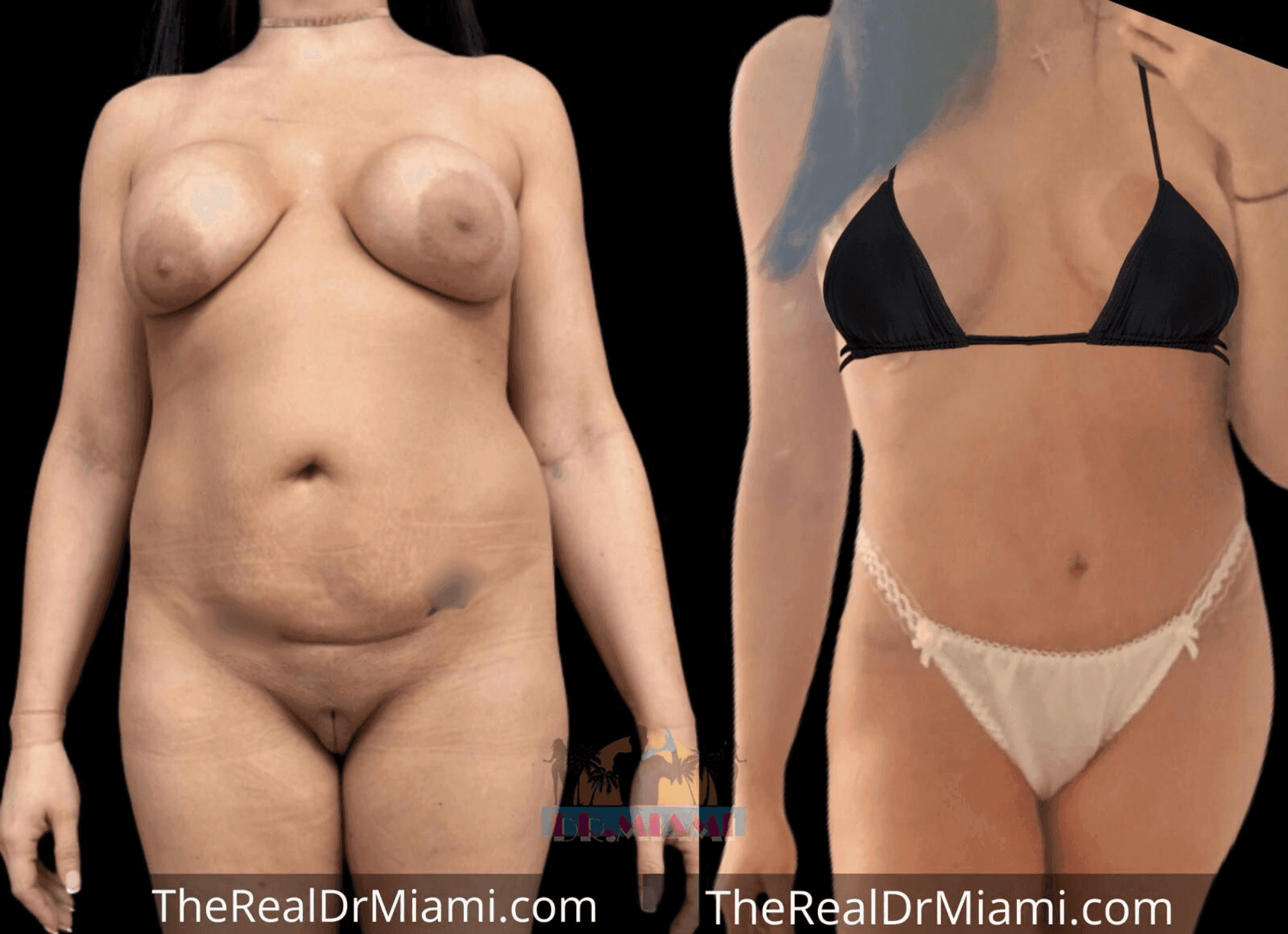 Before-and-after views for Mommy Makeover, Case 36.
