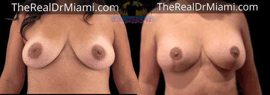 Before-and-after views for Breast Lift, Case 73.