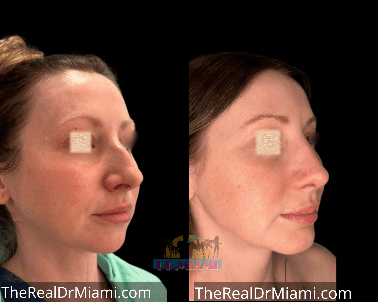 Before-and-after views for Rhinoplasty, Case 11.