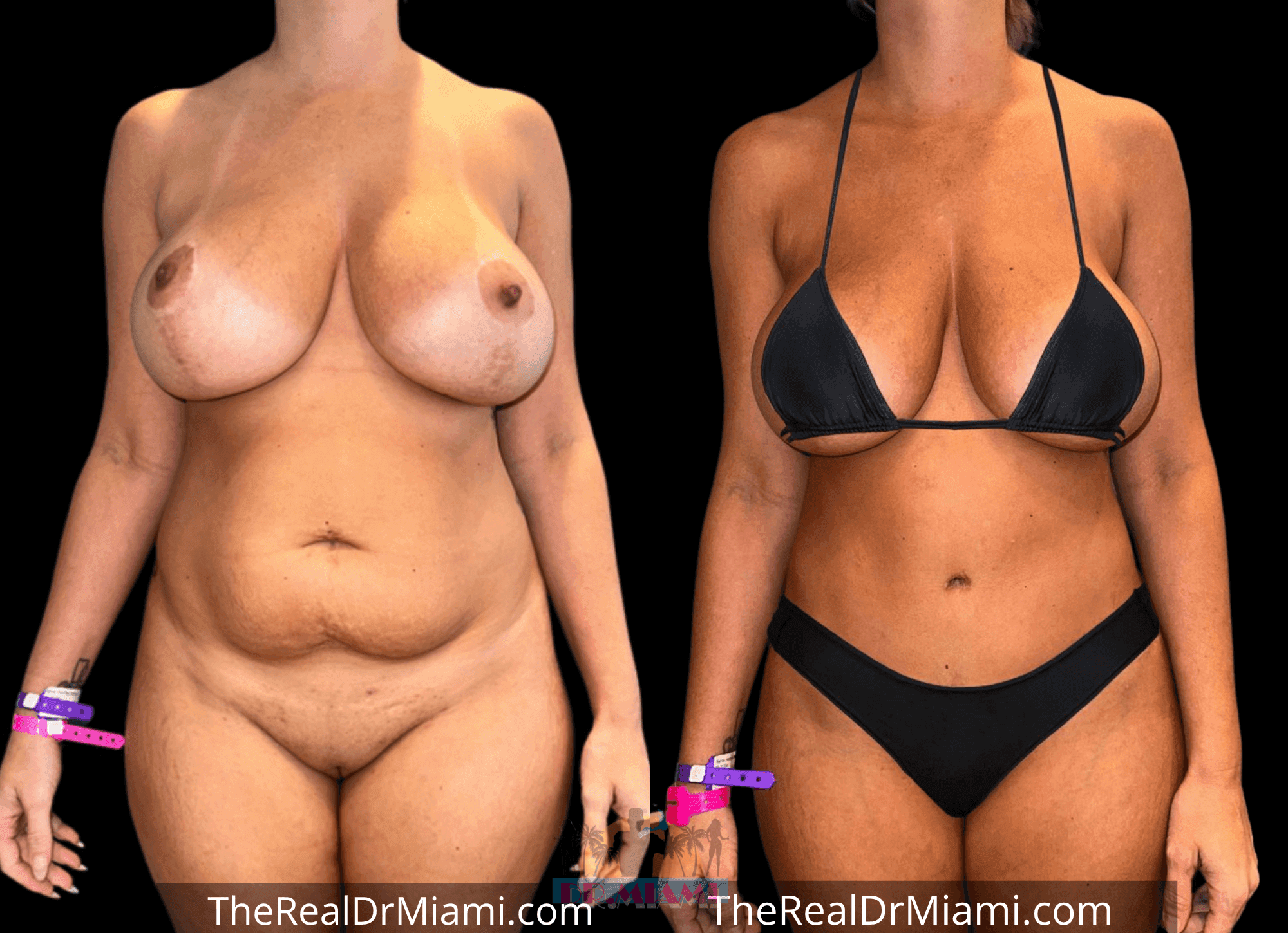 Before-and-after views for Tummy Tuck, Case 47.