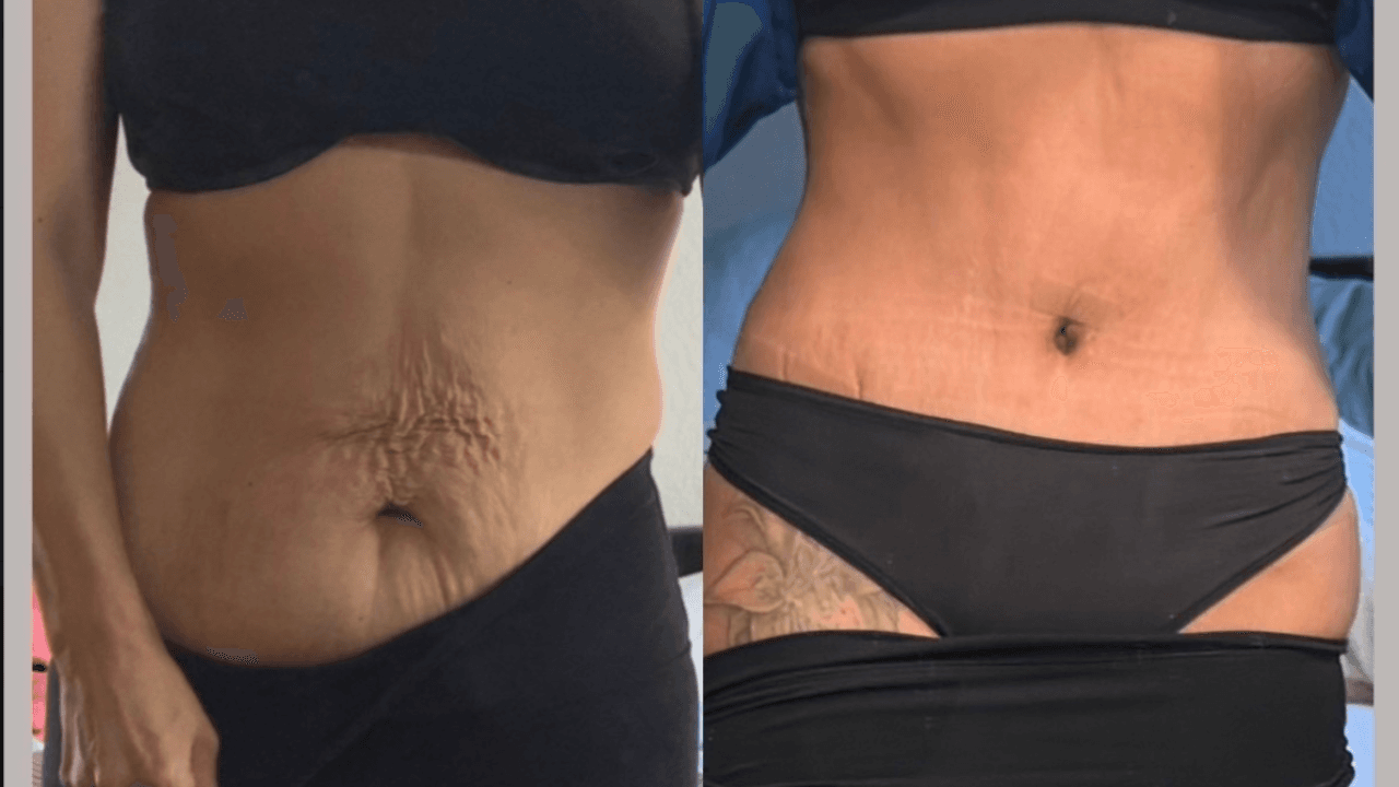 Before-and-after views for Tummy Tuck, Case 3 from The Next Dr. Miami collection.
