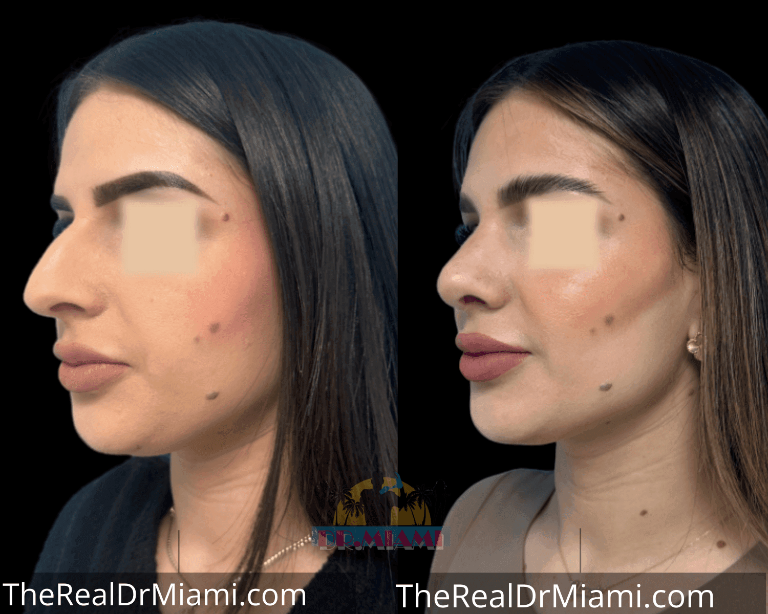 Before-and-after views for Rhinoplasty, Case 58.