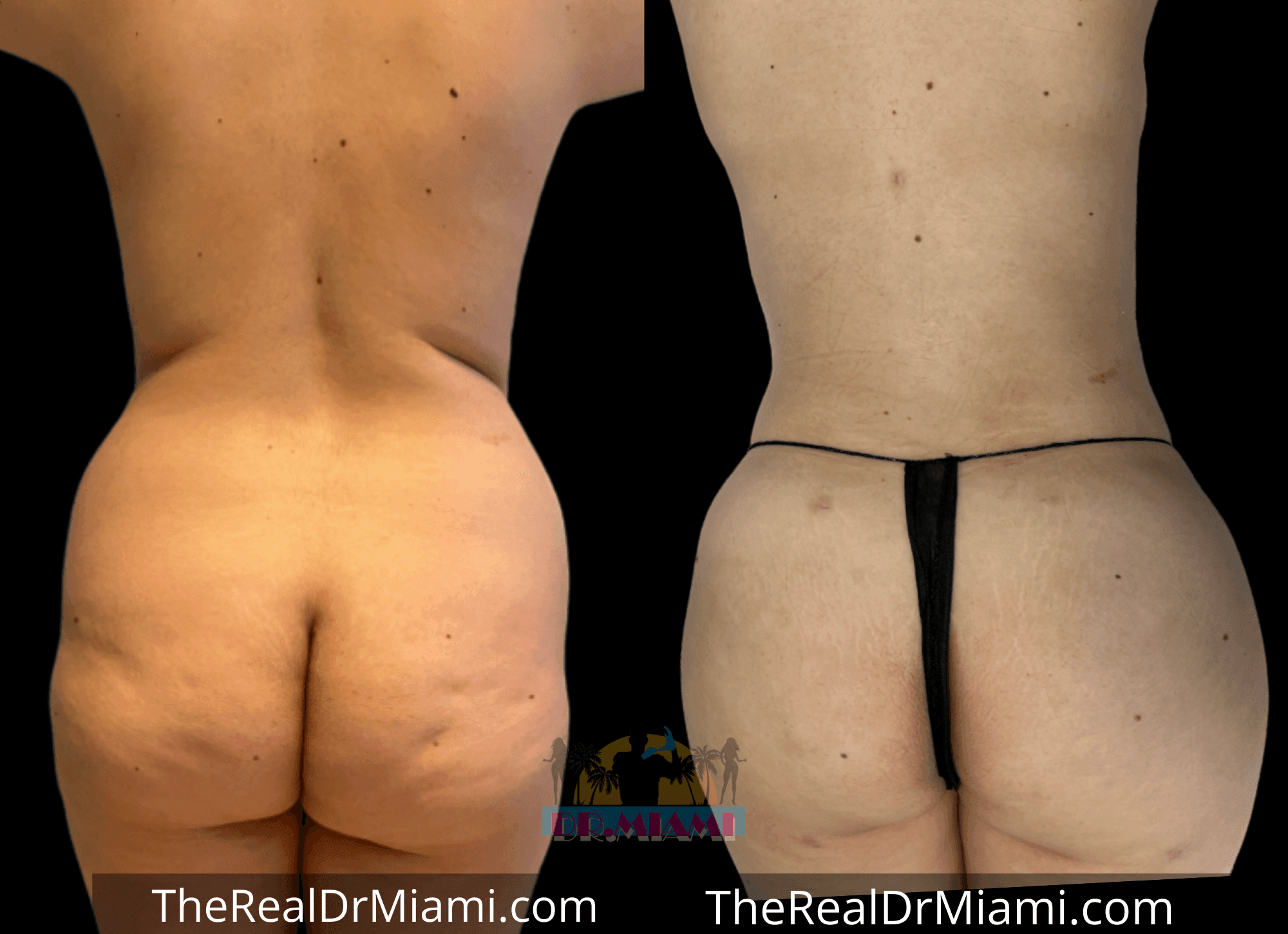 Before-and-after views for Brazilian Butt Lift, Case 14.