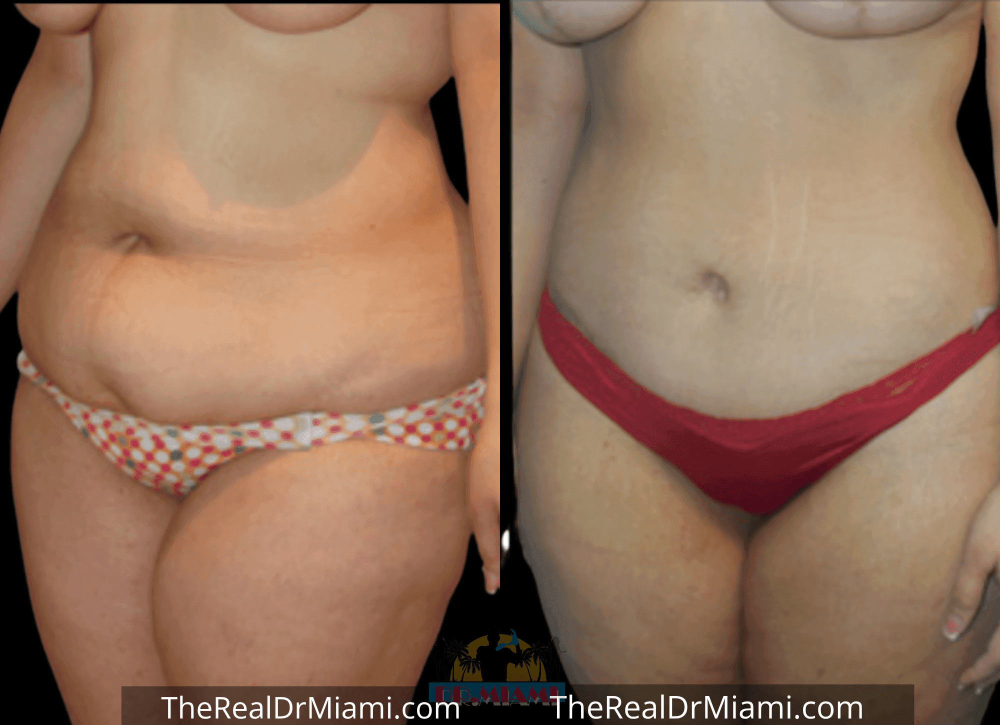 Before-and-after views for Tummy Tuck, Case 79.