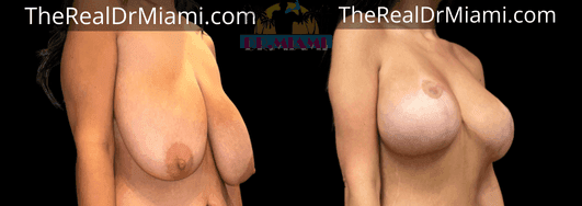 Before-and-after views for Breast Lift, Case 87.