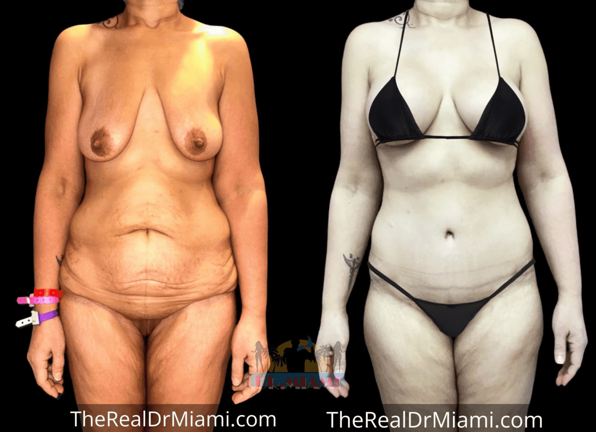 Before-and-after views for Mommy Makeover, Case 34.