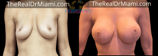 Before-and-after views for Breast Lift, Case 52.