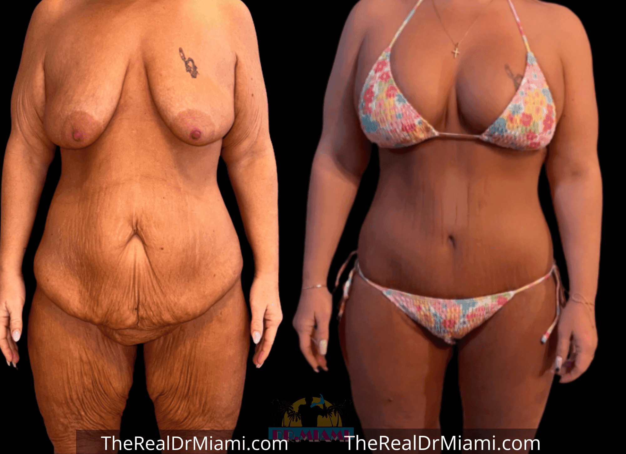 Before-and-after views for Tummy Tuck, Case 36.