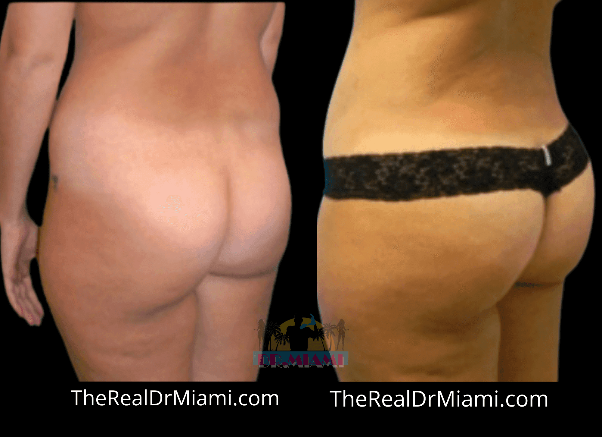 Before-and-after views for Brazilian Butt Lift, Case 59.