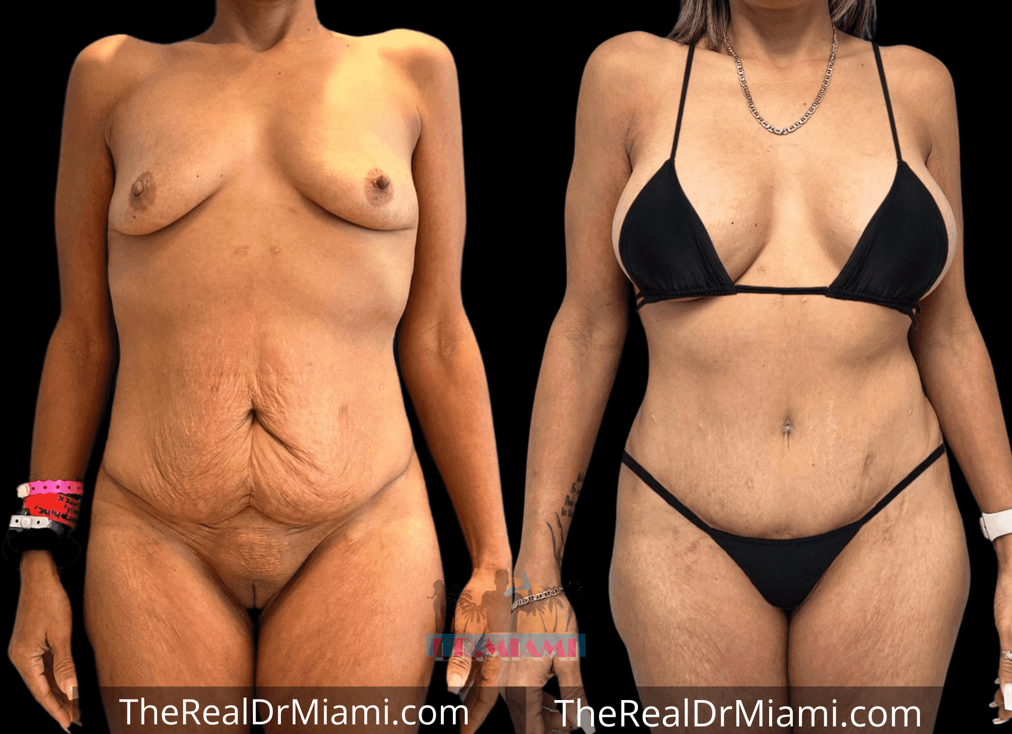 Before-and-after views for Mommy Makeover, Case 78.