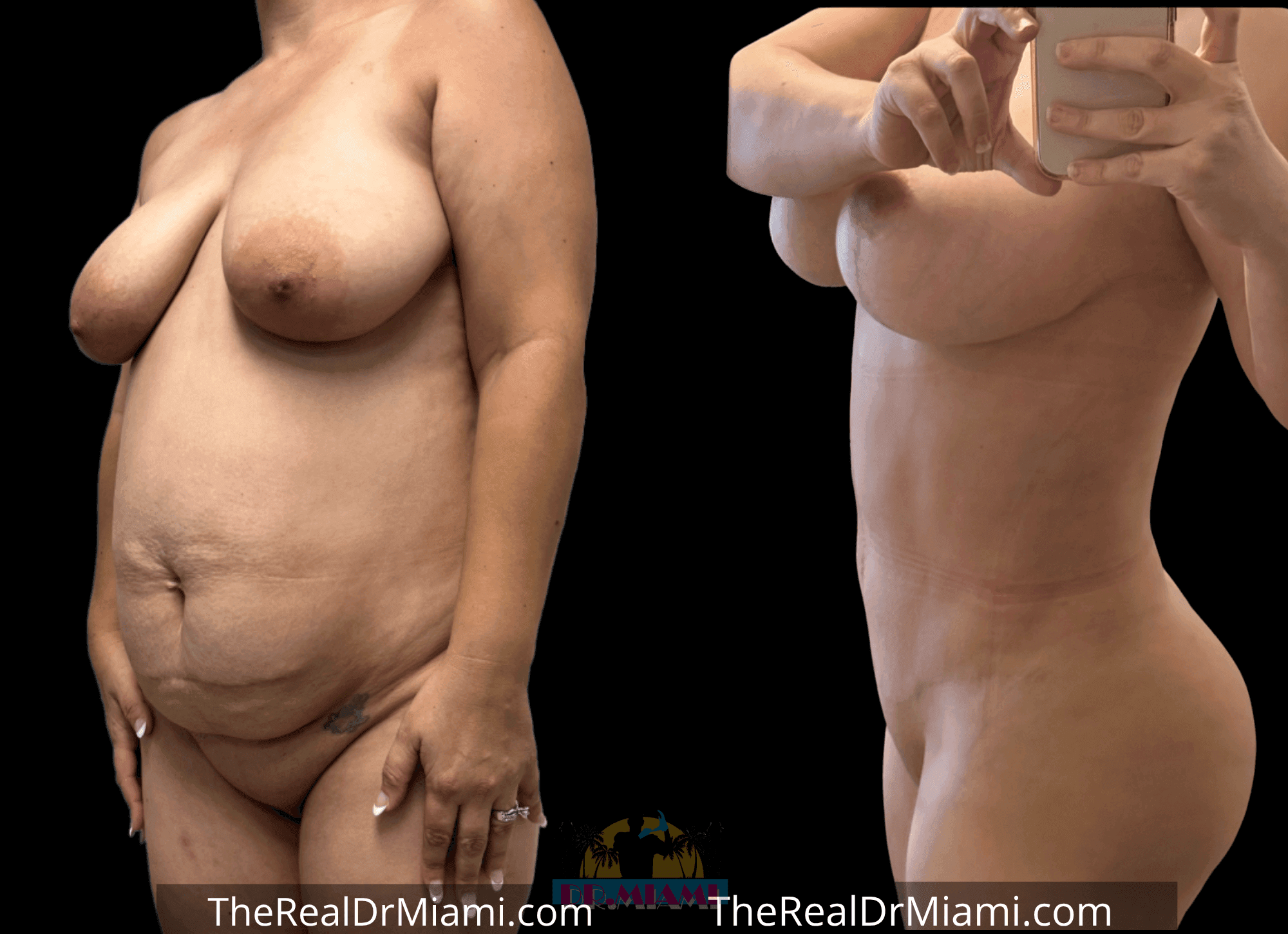 Before-and-after views for Tummy Tuck, Case 106.