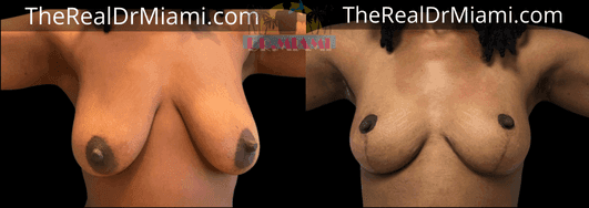 Before-and-after views for Breast Lift, Case 62.