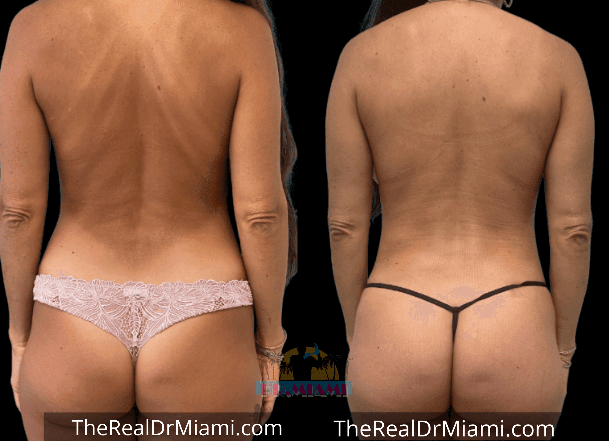 Before-and-after views for Brazilian Butt Lift, Case 80.