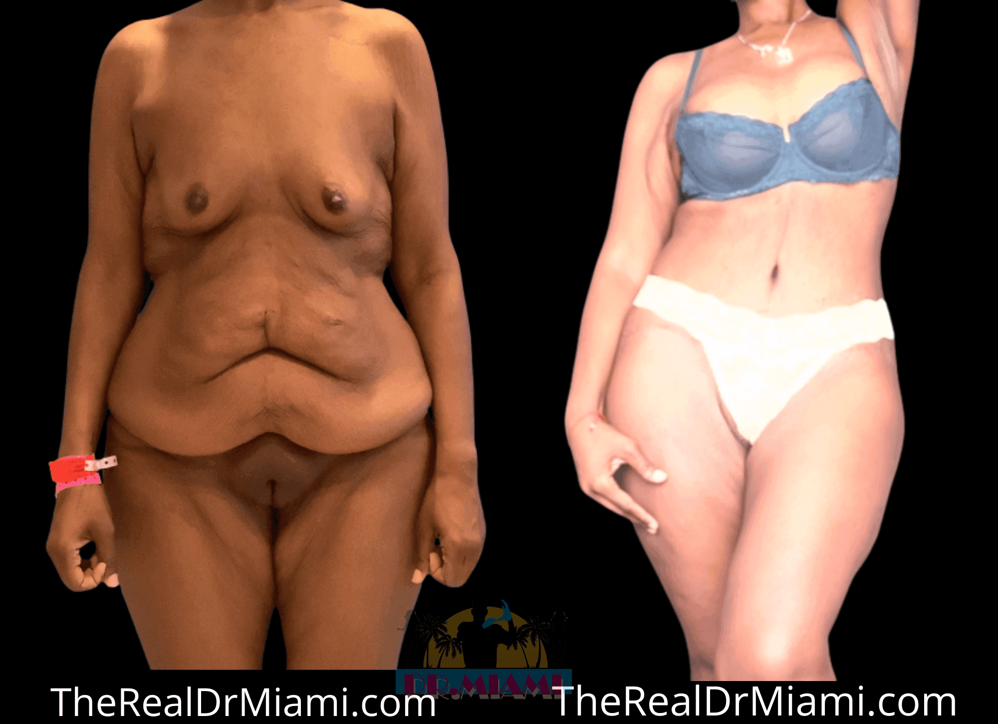Before-and-after views for Massive Weight Loss, Case 38.