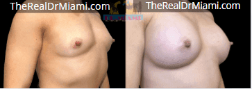 Before-and-after views for Breast Augmentation, Case 43.