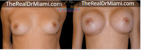 Before-and-after views for Breast Augmentation, Case 122.