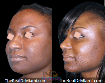 Before-and-after views for Rhinoplasty, Case 61.
