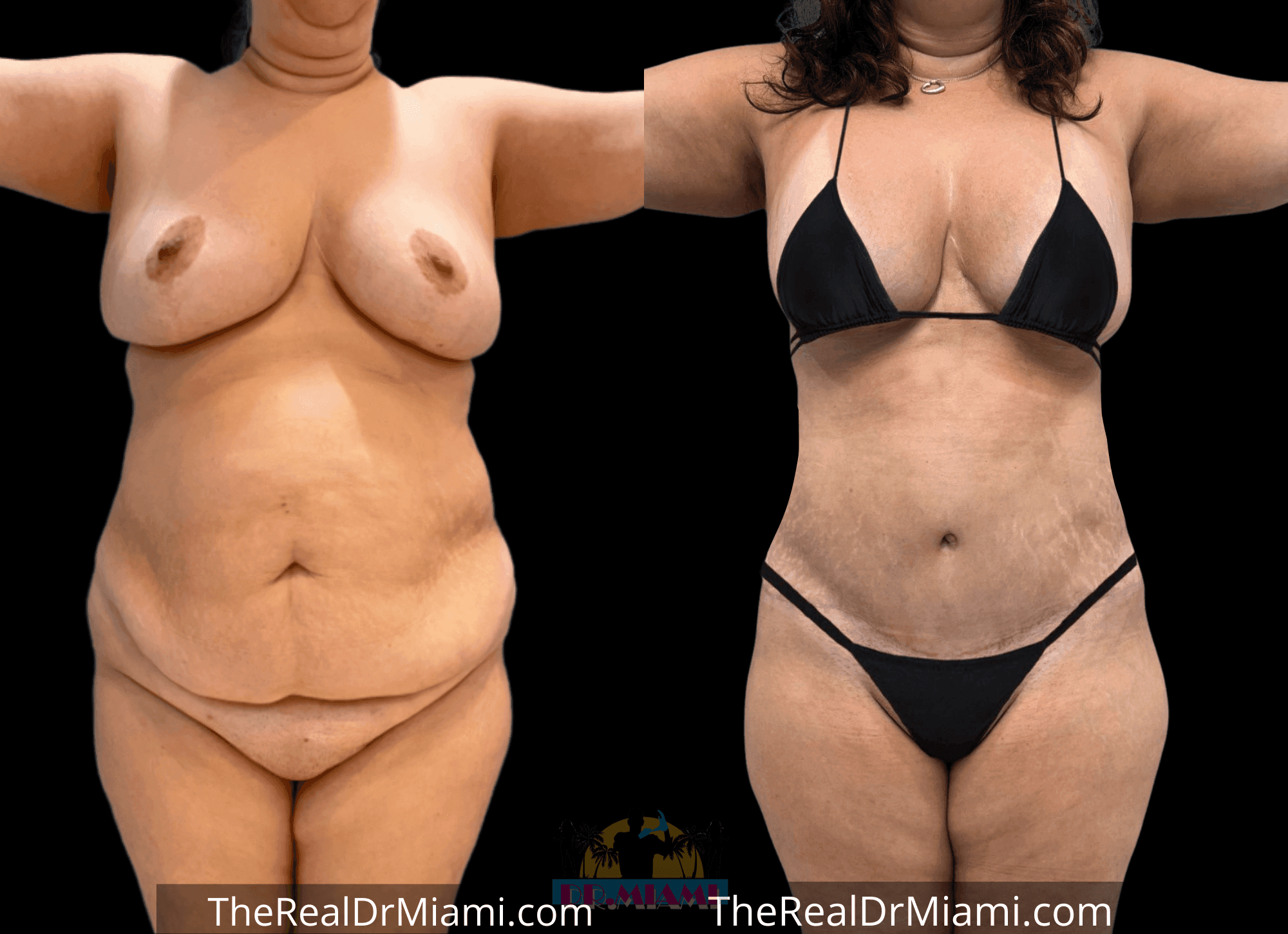 Before-and-after views for Tummy Tuck, Case 110.