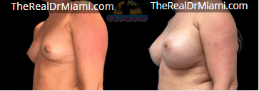 Before-and-after views for Breast Augmentation, Case 40.