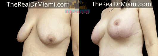 Before-and-after views for Breast Lift, Case 89.