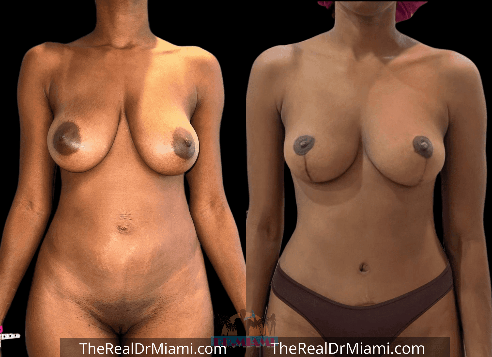 Before-and-after views for Mommy Makeover, Case 25.