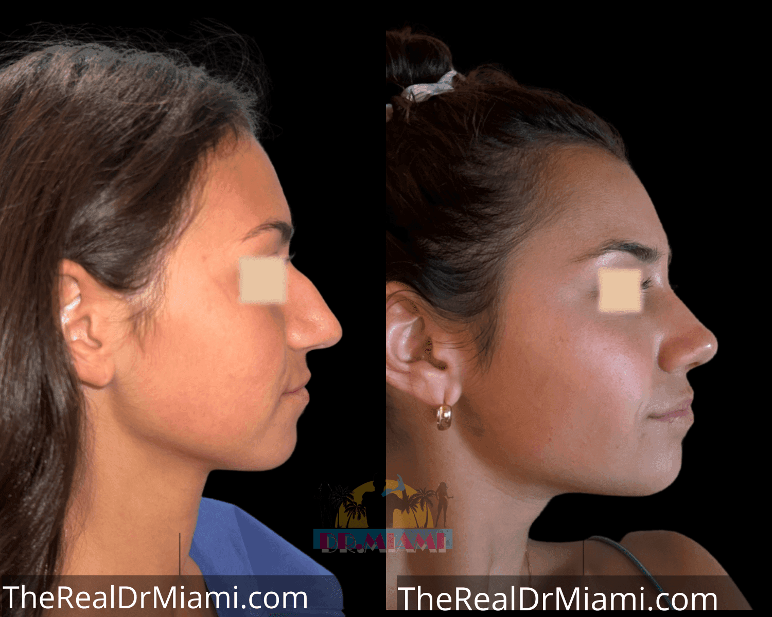 Before-and-after views for Rhinoplasty, Case 51.