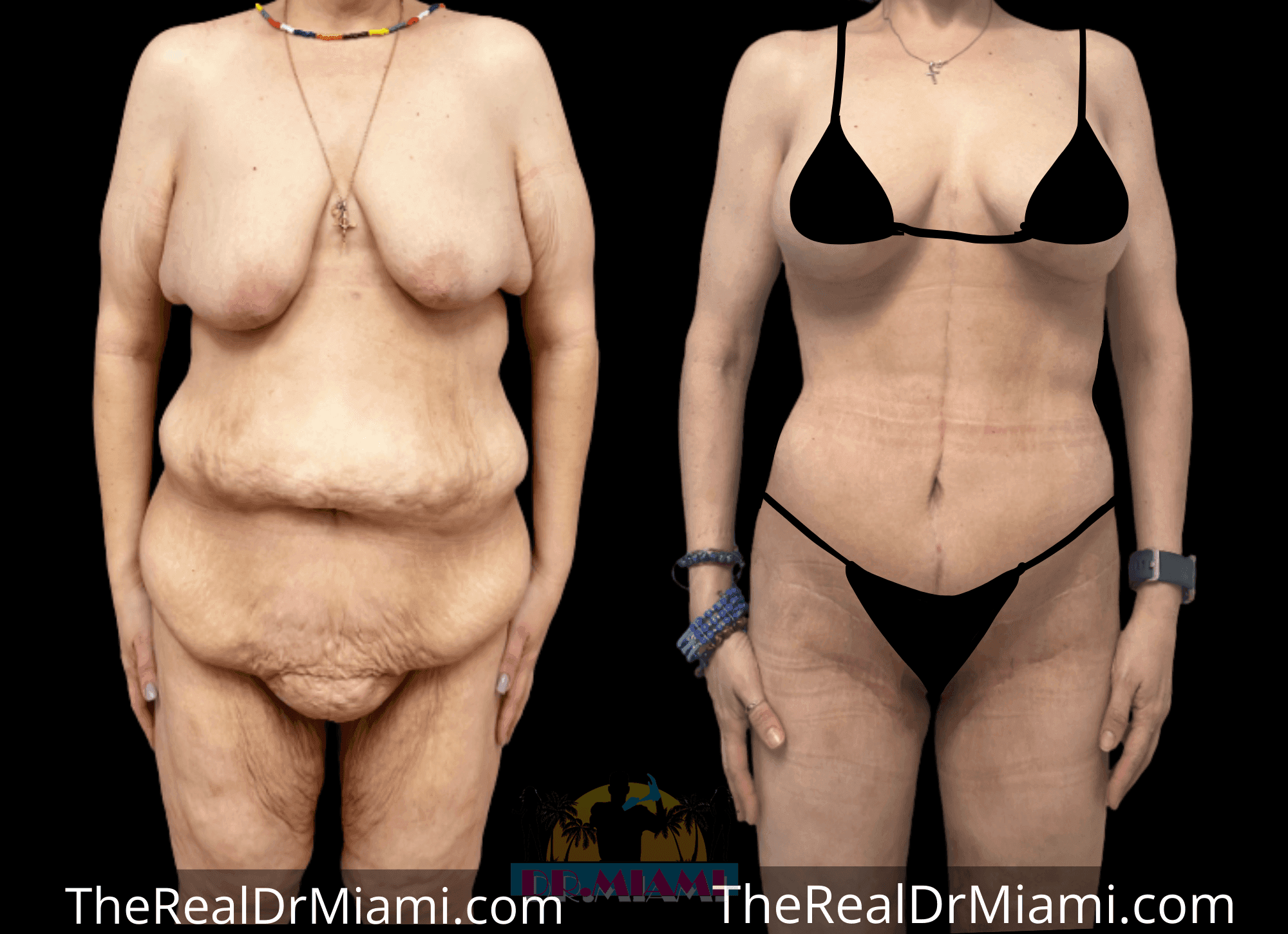Before-and-after views for Massive Weight Loss, Case 12.